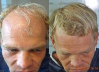 45-54 year old man treated with FUE Hair Transplant