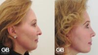 45-54 year old woman treated with Rhinoplasty