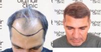 45-54 year old man treated with Hair Transplant, FUE Hair Transplant
