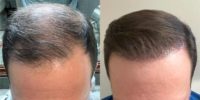 45-54 year old man treated with Hair Transplant, NeoGraft, FUE Hair Transplant