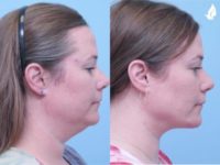 45-54 year old woman treated with Buccal Fat Removal, Neck Lift