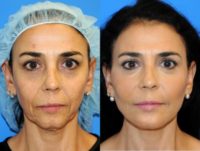 47 year old woman treated with the Y LIFT® - Instant, Non-Surgical Facelift
