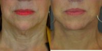 45-54 year old woman treated with Neck Lift, Lip Lift