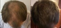 45-54 year old man treated with FUT Hair Transplant