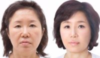 45-54 year old woman treated with SMAS Facelift/eyelid surgery/nasolabial folds surgery.