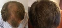 45-54 year old man treated with Hair Transplant