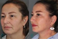 45-54 year old woman treated with Facelift, Facial Fat Transfer, Eyelid Surgery