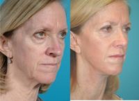 52 year old woman treated with Facelift