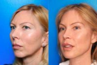 45-54 year old woman treated with Facelift with Chin Surgery