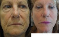 45-54 year old woman treated with Laser Treatment