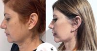 45-54 year old woman treated with Deep Plane Facelift