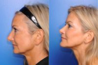 55-64 year old woman treated with Facelift and Chin Surgery