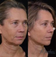 55 year old man treated with Deep Plane Facelift
