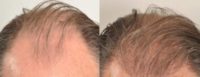 55-64 year old man treated with Hair Transplant