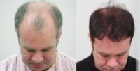 55-64 year old man treated with FUE Hair Transplant