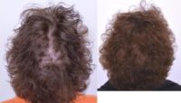 55-64 year old woman treated with female pattern hair loss with Low-level laser therapy