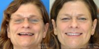 58 year old woman treated with All-on-4 and Zygomatic Dental Implants
