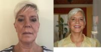 55-64 year old woman treated with SMAS Facelift