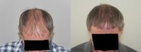 55-64 year old man treated with Hair Transplant