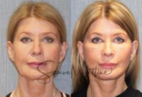 55-64 year old woman treated with Face and Neck lift
