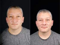 55-64 year old nonbinary person treated with Rhinoplasty