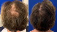 65-74 year old woman treated with Hair Loss Treatment