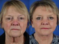 66 year old woman treated with Facelift, Upper and Lower Blepharoplasty, and Laser Skin Resurfacing