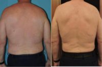 65-74 year old man treated with Liposuction