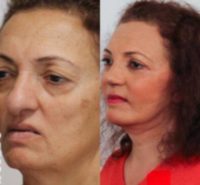 65-74 year old woman treated with Facelift