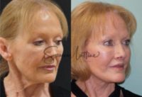 65-74 year old woman treated with Facelift Revision