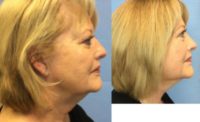 73 year old in office neck lift