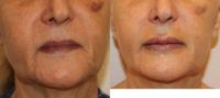 65-74 year old woman treated with Lip Implants