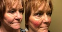 65-74 year old woman treated with Restylane Lyft