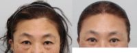 65-74 year old woman treated with Facelift, Liposuction, Eyelid Surgery