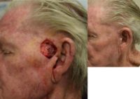 75 and up year old man treated with Facial Reconstructive Surgery