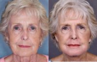 75 and up year old woman treated with Facelift