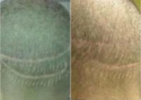 Before And After FUE scar repair, 1000 grafts