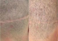 Before And After Scar Repair, 34 years old male, 200 grafts