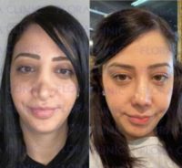 25-34 year old woman treated with Rhinoplasty