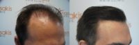 An excellent result with less than 2300 follicular units