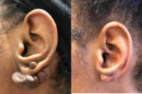 Woman treated with Ear Lobe Surgery