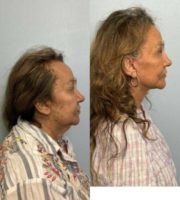 75 year old woman treated with deep plane lower facelift, neck lift, and facial fat transfer