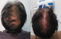 45 year old man treated with PRP Hair Loss Treatment