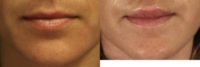 25-34 year old woman treated lip lift