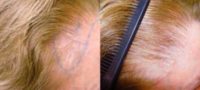 Female Hair Transplant: Before and After Photo