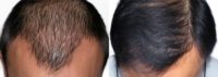 Man treated with Hair Loss Treatment