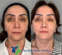 35-44 year old woman treated with Deep Plane Facelift, Neck Lift