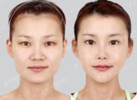 25-34 year old woman treated with Jaw Reduction