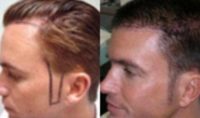25-34 Year Old Man Temporal And Sideburn Reconstruction
