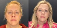 45-54 year old woman treated with Facelift, Eyelid Surgery
